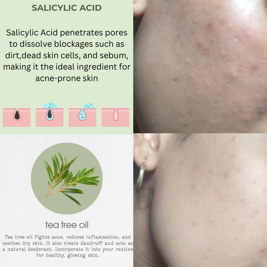 Acne Relief Serum
